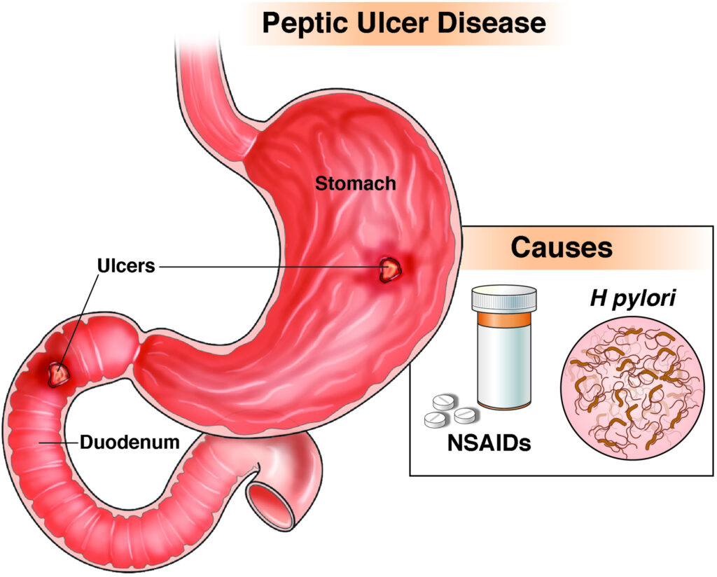 Ulcer. PHOTO CREDITS: American Gastroenterological Association