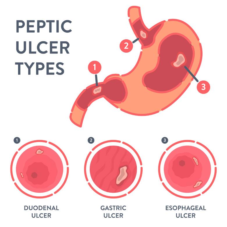 Types of Ulcers